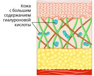 Уменьшение гиалуроновой кислоты