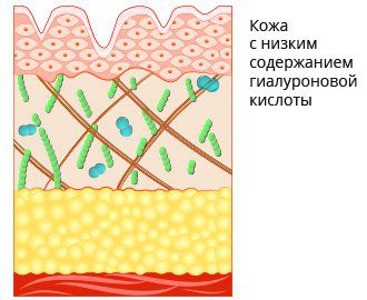 Уменьшение гиалуроновой кислоты