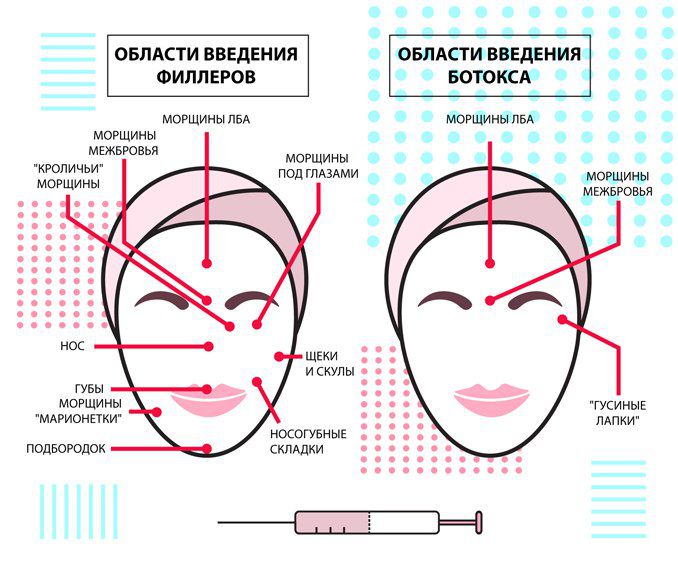 Схемы введения гиалуроновой кислоты и ботокса