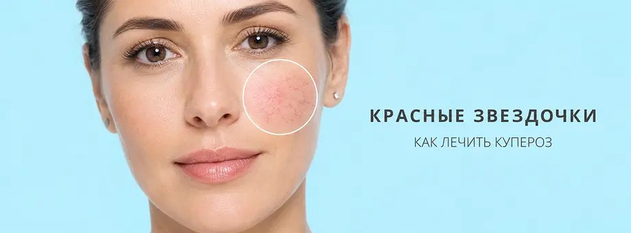 «Красные звездочки»: как лечить купероз