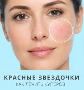 «Красные звездочки»: как лечить купероз