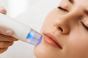 Альтернатива пластической хирургии: МИКРОИГОЛЬЧАТЫЙ RF-лифтинг. Новая эра в омоложении