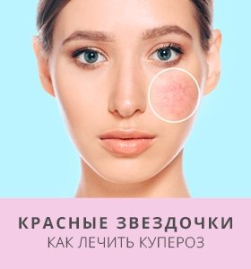 «Красные звездочки»: как лечить купероз